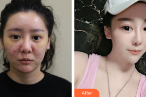 東莞現(xiàn)代女子醫(yī)療美容診所林少冰整形價格表去痘印痘坑案例展示