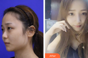 東莞華美女子醫(yī)學美容診所王曉潔整形價格表附鼻子塑造案例展示