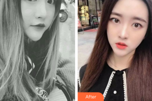 東莞康華醫(yī)院整形美容中心王德宏整形價格表附光學靚膚祛斑案例展示