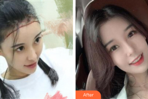 東莞東風醫(yī)療美容中心黃杰整形價格表附種植發(fā)際線案例展示