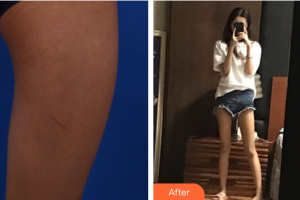 東莞南城人民醫(yī)院醫(yī)學整形美容中心黨小平整形價格表附大腿吸脂案例展示