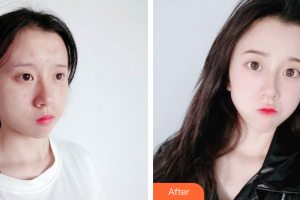 東莞市人民醫(yī)院醫(yī)學美容科整形價格表附祛痘案例展示