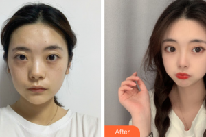 東莞市人民醫(yī)院醫(yī)學美容科劉玉生整形價格表附抗衰修復案例展示