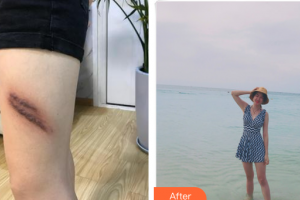 東莞市人民醫(yī)院醫(yī)學美容科廖旭鋒整形價格表附疤痕增生案例展示