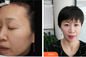 東莞美立方美容醫(yī)院臧劍芳整形價格表附DPLl祛斑案例展示