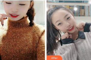 東莞美立方美容醫(yī)院張海鐘整形價格表附超聲波洗牙案例展示