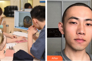 東莞美立方美容醫(yī)院徐霞整形價格表附種植發(fā)際線案例展示