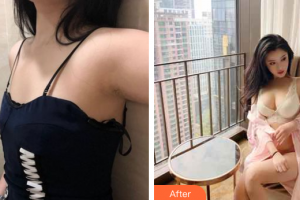 東莞美立方美容醫(yī)院李波整形價格表附假體隆胸案例展示