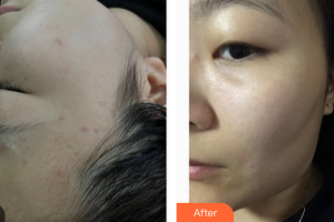 東莞百佳瑪麗亞婦產(chǎn)醫(yī)院何立整形價格表附祛斑案例展示