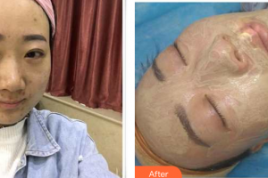 東莞百佳瑪麗亞婦產(chǎn)醫(yī)院趙楊整形價格表附微針案例展示