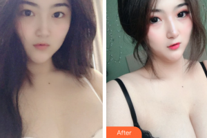 東莞百佳瑪麗亞婦產(chǎn)醫(yī)院金進(jìn)整形價格表附假體隆胸案例展示