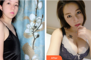 東莞百佳瑪麗亞婦產(chǎn)醫(yī)院柳宣惠整形價格表附假體隆胸案例展示