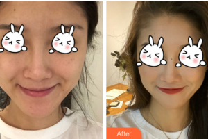 東莞康華醫(yī)院整形美容中心霍麗貞整形價格表附光子嫩膚案例展示