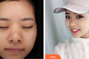 東莞締美整形美容醫(yī)院Dr.MichaelHGold整形價格表附白瓷光美白案例展示