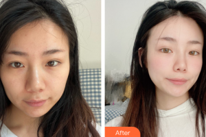 東莞瑞芙臣醫(yī)療美容門診部Mainguy整形價格表附埋線提升案例展示