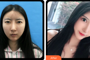 東莞瑞芙臣醫(yī)療美容門診部JianFarhadi整形價格表附眼部綜合案例展示