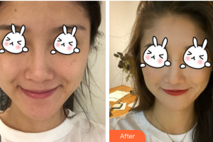 東莞美立方美容醫(yī)院湯曉姝整形價格表附光子嫩膚案例展示