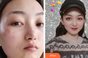 東莞美立方美容醫(yī)院王繼文整形價格表附超激光美膚+祛斑針案例展示