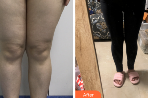 東莞瑞芙臣醫(yī)療美容門診部樸太赫整形價格表附全身吸脂案例展示