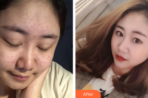 東莞韓美整形醫(yī)院趙德印主診醫(yī)師整形價格表附祛痘案例展示