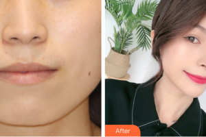 東莞華美醫(yī)療美容醫(yī)院樸莉玲整形價格表附超激光美膚嫩膚案例展示