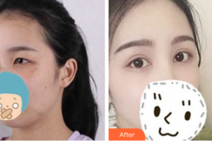 東莞華美醫(yī)療美容醫(yī)院李佳輝整形價格表附眼部手術案例展示