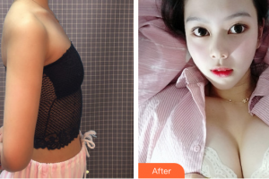 東莞華美醫(yī)療美容醫(yī)院劉正淵整形價格表附胸部整形案例展示