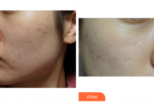 東莞寶格麗醫(yī)療美容門診部唐可可整形價格表附清潔祛痘案例展示