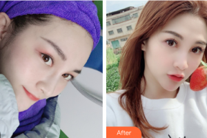 東莞韓美整形醫(yī)院劉小婷整形價格表附水光補水案例展示