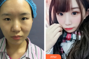 東莞非凡美容醫(yī)院顏江整形價格表附眼部綜合案例展示