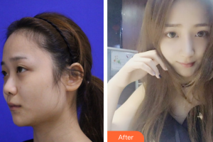 東莞寶格麗醫(yī)療美容門診部胡峻齊整形價格表附鼻子塑造案例展示