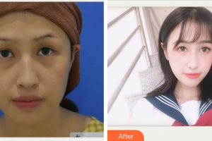 東莞君熠醫(yī)療美容診所胥恒整形價格表附激光去眼袋案例展示