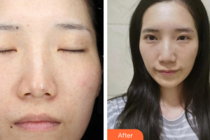 東莞寶格麗醫(yī)療美容門診部林曉娟整形價格表附激光祛斑案例展示