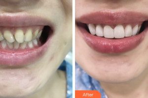 東莞美立方美容醫(yī)院肖連永整形價格表附牙齒貼片案例展示