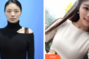 東莞市第六人民醫(yī)院醫(yī)療美容中心羅海燕整形價格表附自體脂肪隆胸案例展示