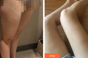 東莞同濟光華醫(yī)院口腔科郭愛華整形價格表附大腿吸脂案例展示