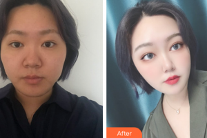 東莞美立方美容醫(yī)院謝子才整形價格表附面部埋線提升提升案例展示