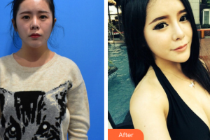 東莞同濟光華醫(yī)院口腔科戴新明整形價格表附自體脂肪隆胸案例展示