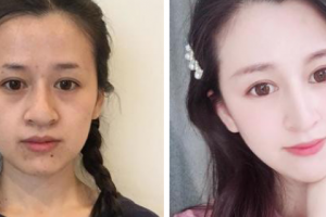 武漢明星醫(yī)學整形美容醫(yī)院李欣融整形價格表附激光祛斑案例展示