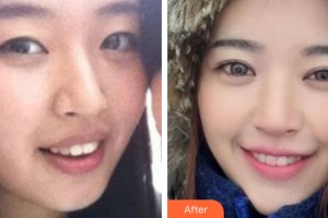 河南省整形美容研究中心范學(xué)文整形價(jià)格表附牙齒矯正案例展示