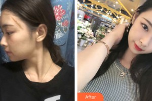 河南大學附屬南石醫(yī)院燒傷整形美容中心楊洪整形價格表附皮膚美容案例展示