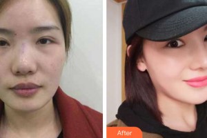 河南大學附屬南石醫(yī)院燒傷整形美容中心楊丙厚整形價格表附隆鼻手術案例展示