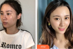 河南大學附屬南石醫(yī)院燒傷整形美容中心趙學建整形價格表附皮膚美容案例展示