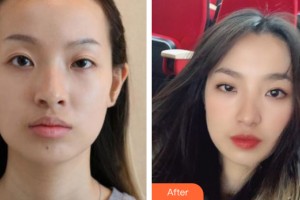 河南省現(xiàn)代醫(yī)學研究院中醫(yī)院七星整形美容中心范廣振整形價格表附植發(fā)案例展示