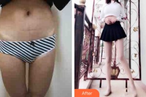 河南科技大學第一附屬醫(yī)院整形美容科徐興軍整形價格表附大腿吸脂案例展示