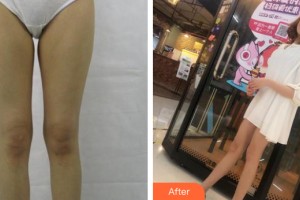河南整形美容醫(yī)院白玉龍整形價格表附大腿吸脂案例展示