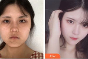 河南省整形美容研究中心李媛整形價格表附皮膚美容案例展示