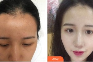 河南省整形美容研究中心馬中望整形價格表附植發(fā)案例展示