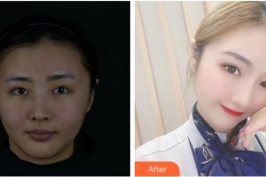 河南大學第一附屬醫(yī)院醫(yī)療美容科陳春瑞整形價格表附皮膚美容案例展示