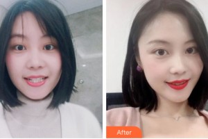 武警河南省總隊醫(yī)院激光整形中心路學文整形價格表附牙齒矯正案例展示